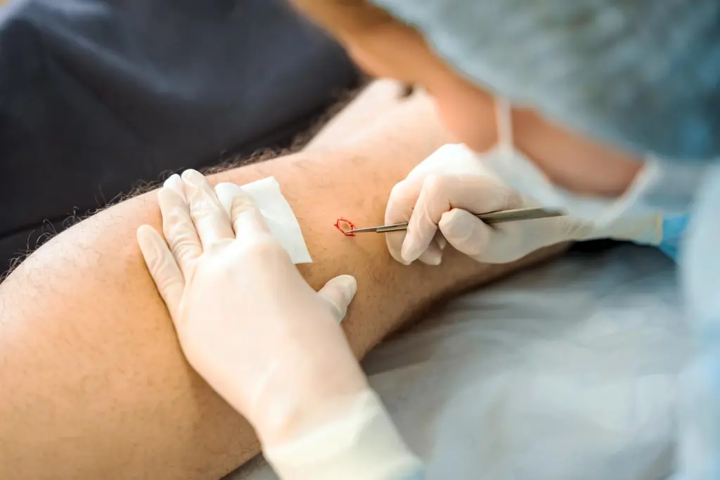 Extirpación por capas