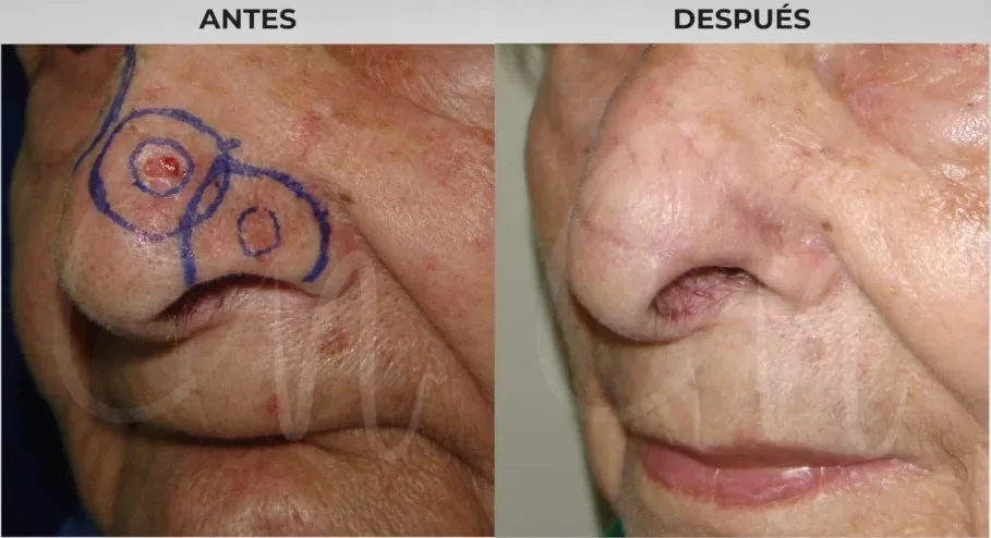 Reconstrucción final