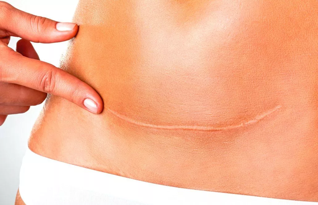 Tratamiento Cicatrices